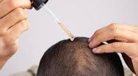 Hair Loss